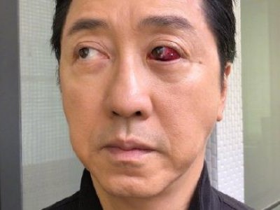 庾澄庆眼睛受伤 照片曝光很吓人受伤原因是什么呢