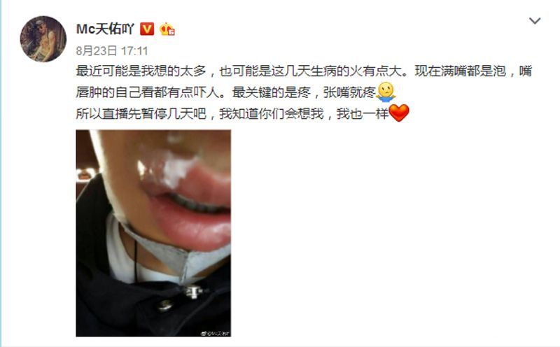 天佑嘴肿暂退网络！佑家军纷纷评论支招！