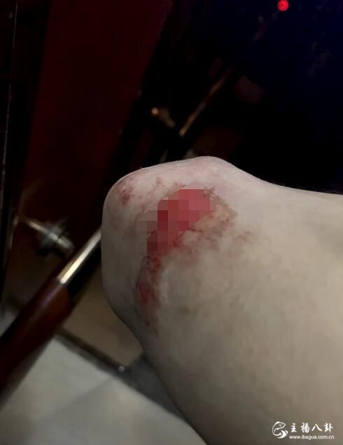 祁天道腿部意外摔倒受伤！