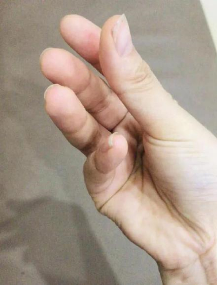 女生手指呈鸡爪状