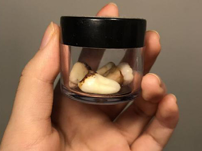 智齿的真实面目以及由来 智齿到底应不应该拔？