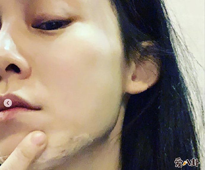 范玮琪下巴缝15针