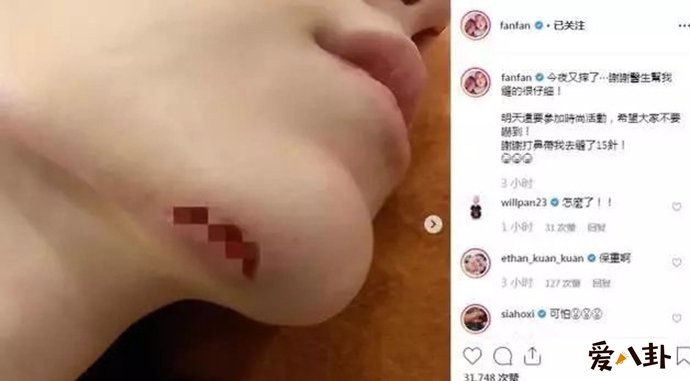 范玮琪下巴缝15针