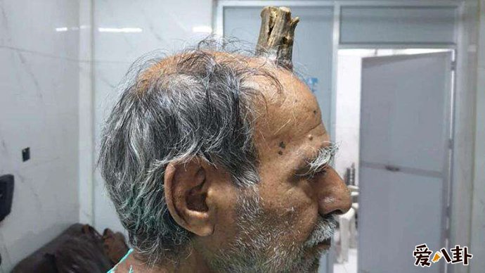 印度男子头部长出牛角