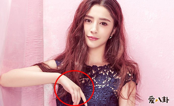 李心艾的手怎么了