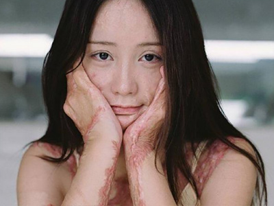 烧伤毁容周岩现状如何 她原本长相是怎么样的